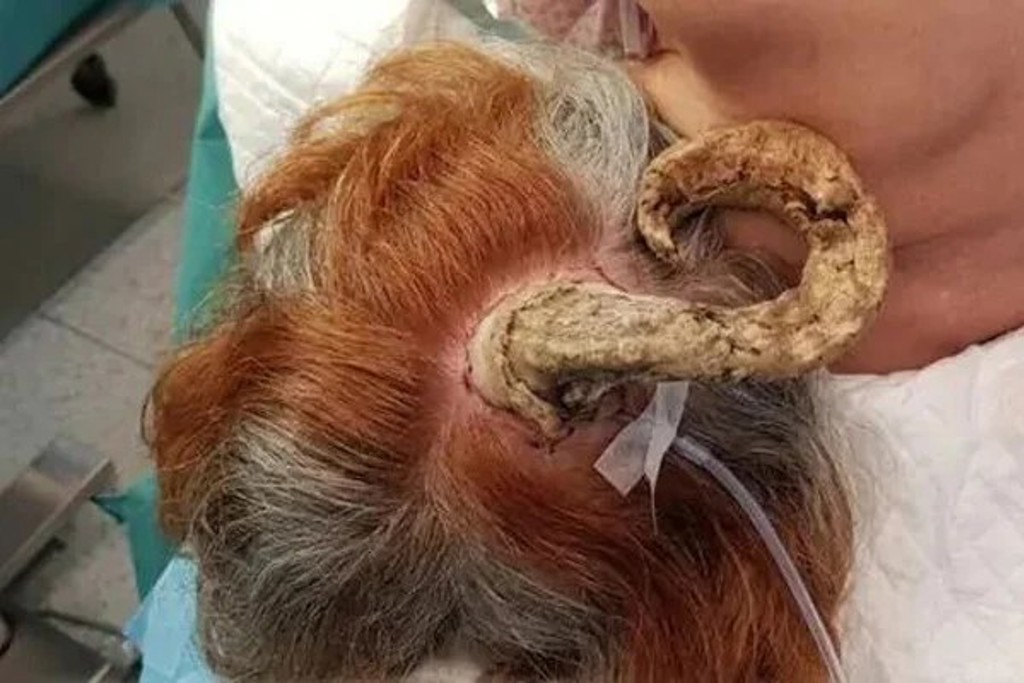 泰國75歲婦人頭上長出26公分的角,就醫後才知道竟是皮膚癌作祟險侵頭骨。(翻攝網路)